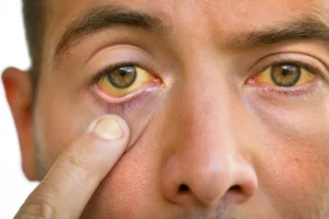 Jaundice is a yellowing of the eyes or skin, commonly caused by liver disease